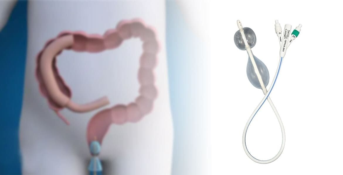 Diagram of a human colon with a colostomy, shown next to a medical device with two balloons and connecting tubes, likely for bowel management.