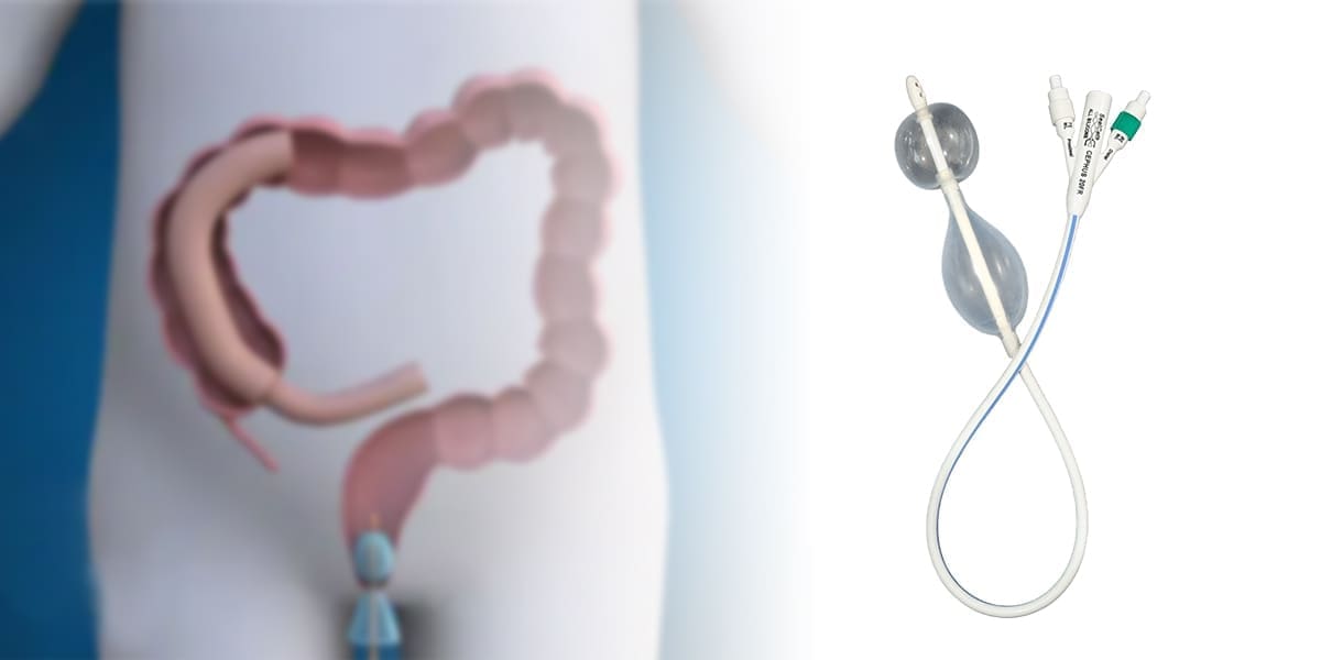 Diagram of a human colon with a colostomy, shown next to a medical device with two balloons and connecting tubes, likely for bowel management.